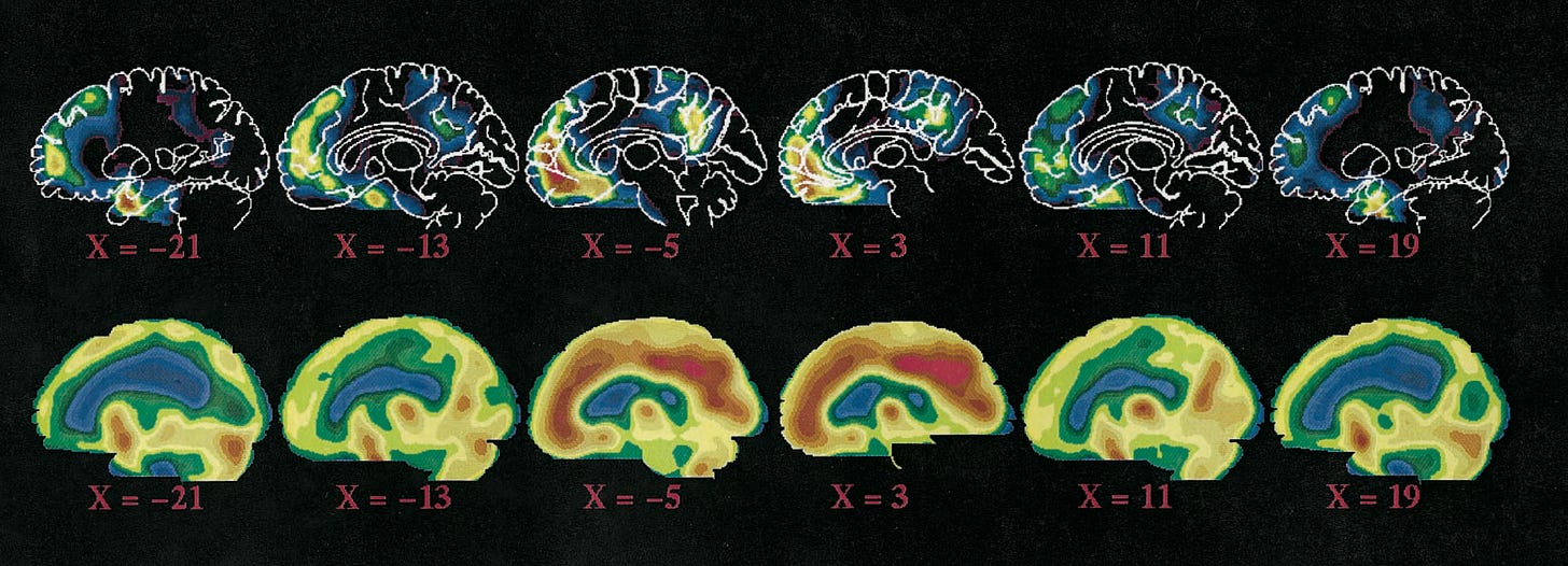 Figure 3. [Raichle et al. (2001)] “Regions of the brain regularly observed to decrease their activity during attention-demanding cognitive tasks shown in sagittal projection (Upper) as compared with the blood flow of the brain while the subject rests quietly but is awake with eyes closed (Lower).”