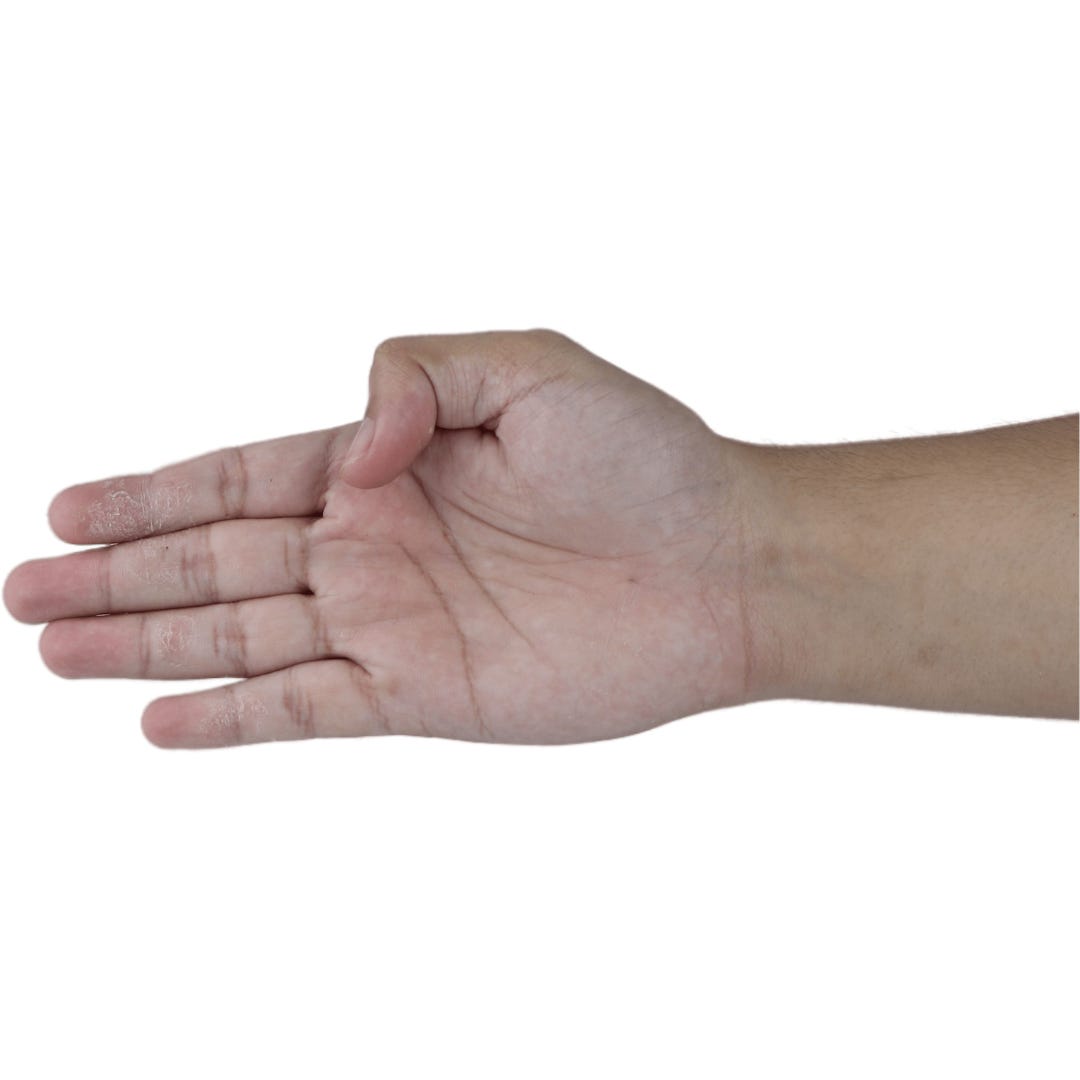 a hand with 4 fingers