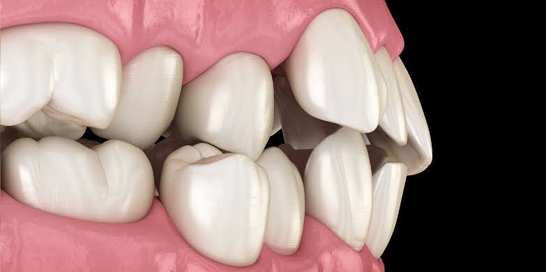 Misaligned Teeth (Malocclusion) - Eastern Dental