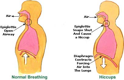 Hiccups Treatment, Causes, Remedies Hiccups Picture