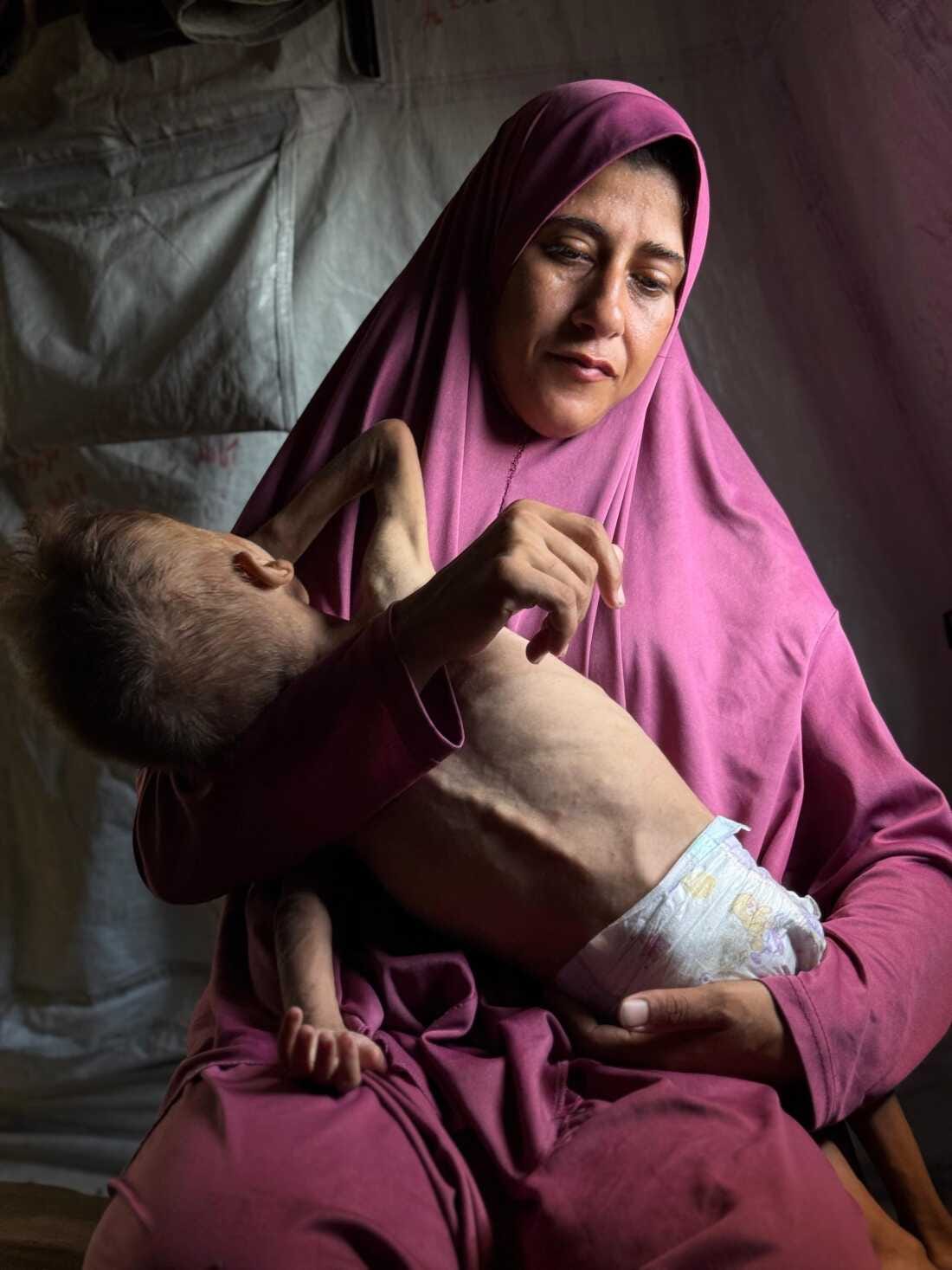 Gaza children's health damaged permanently by malnutrition, doctors warn :  NPR