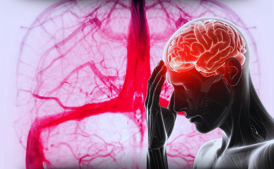 Trombose cerebral: o que é, sintomas, causas e tratamento
