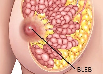 Blebs: How can you treat them? - Bleb | Blocked Duct | Mastitis