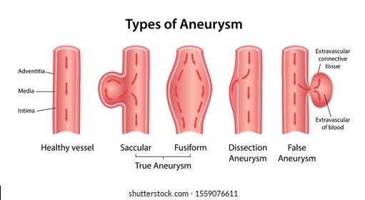 Types Aneurysm True Aneurysm Saccular Fusiform Stock Vector (Royalty Free)  1559076611 | Shutterstock