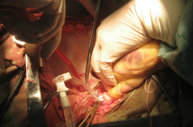 Heart Donor Heart Donor