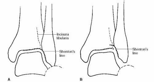 Ankle Fracture Malunion and Late Syndesmosis Reconstruction |  Musculoskeletal Key