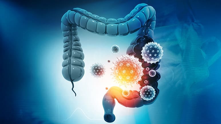 vitamin d helps lower risk of colorectal cancer