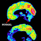 Psychopathy and Sociopathy