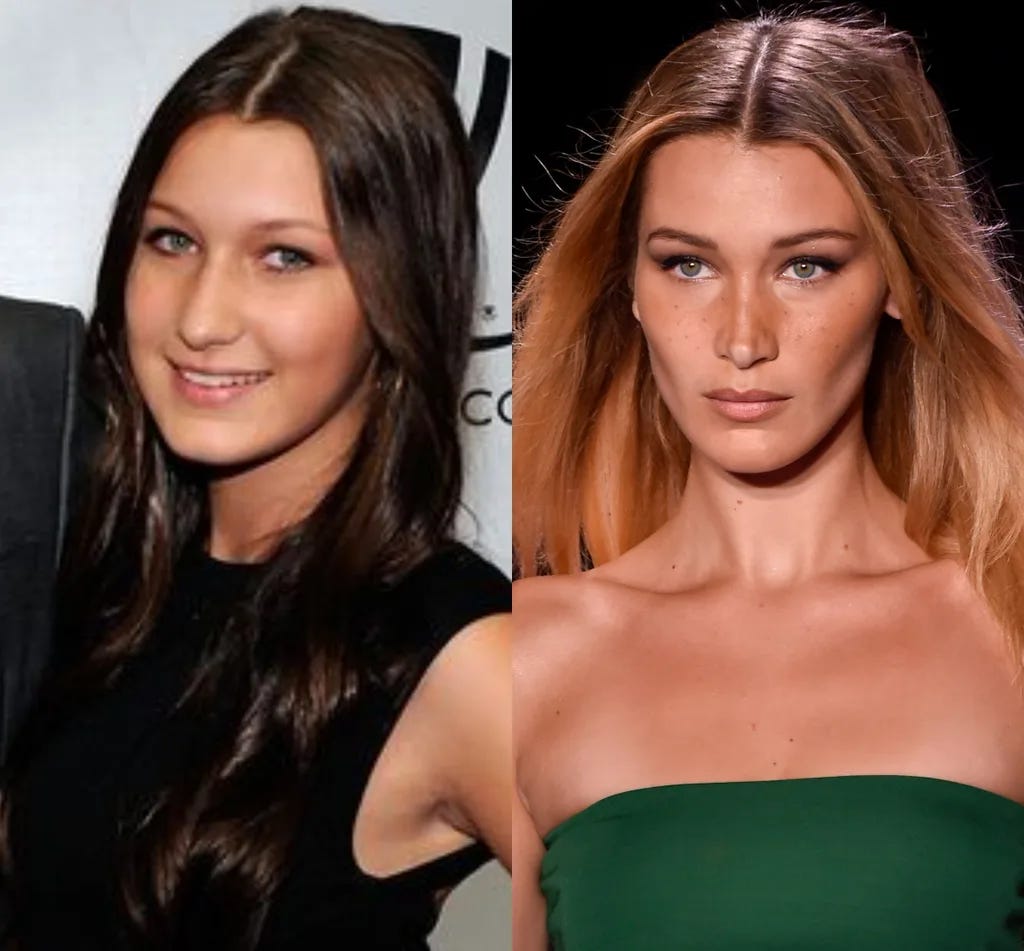 Bella Hadid plastic surgery: Before and after | WHO