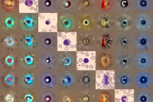 Different types of blood cells analysed by CytoDiffusion, a generative AI tool used to detect abnormalities in blood samples.