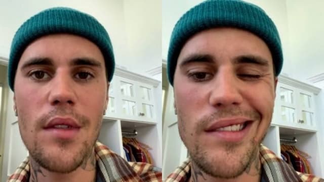 O cantor Justin Bieber foi diagnosticado com a síndrome de Ramsay Hunt, que paralisou metade de seu rosto.