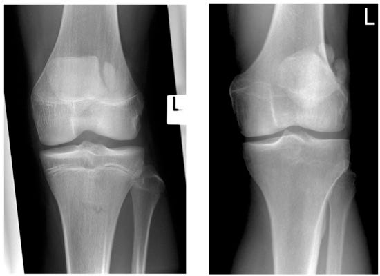 Pediatric Knee Trauma Radiographic Evaluation - Pediatrics - Orthobullets