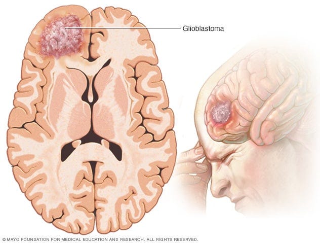 Glioblastoma - Symptoms and causes - Mayo Clinic Glioblastoma - Symptoms and causes - Mayo Clinic