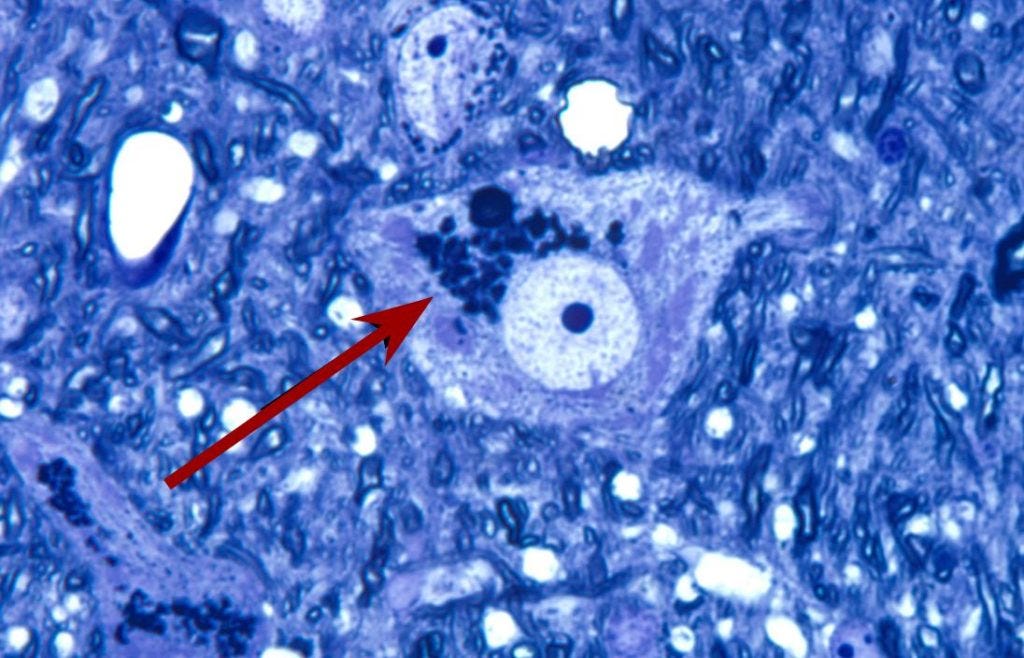 An accumulation of junk (lipofuscin granules) in a brain cell. Image Credit: Wikimedia An accumulation of junk (lipofuscin granules) in a brain cell. Image Credit: Wikimedia
