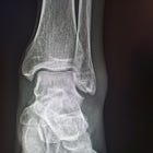 From Injury to Recovery: A Tennis Player's Journey with Hyperbaric Therapy and Percutaneous Hydrotomy
