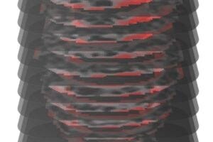 A contrast-enhanced cardiac MRI shows the heart of a patient with hypertrophic cardiomyopathy, identified by MAARS as high risk for sudden cardiac death. Each image slice reveals a progression from dark areas (healthy heart tissue) to bright areas (fibrotic, abnormal tissue). The AI highlights the regions with the most fibrosis in red.