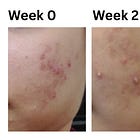 From bleeding pimples to no acne in under 8 weeks - what tackling acne from the inside-out actually looks like