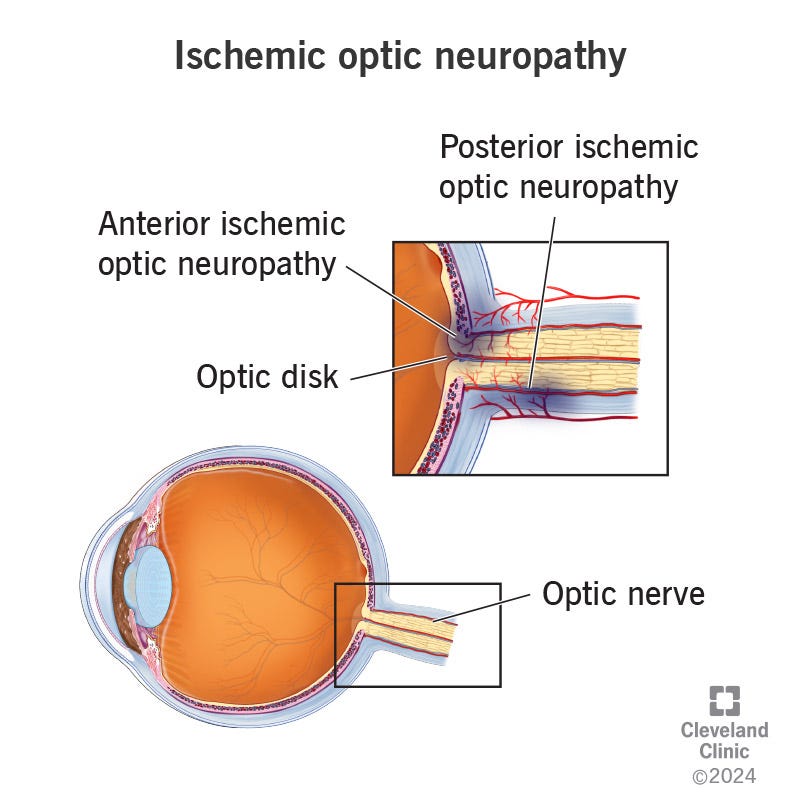 Lack of blood flow causes ischemic optic neuropathy, damaging the anterior (front) and posterior (rear) of the optic nerve Lack of blood flow causes ischemic optic neuropathy, damaging the anterior (front) and posterior (rear) of the optic nerve