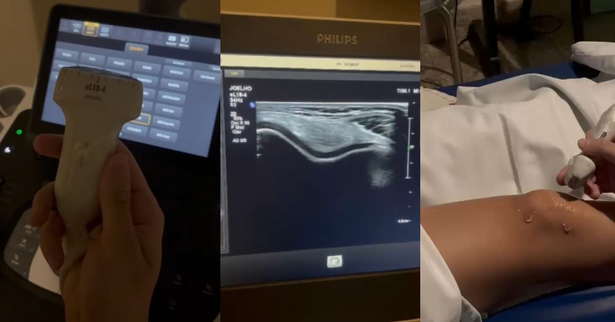 Descrição: Montagem com três imagens: uma mão segurando um aparelho transdutor de ultrassom; um monitor de vídeo mostrando uma imagem de ultrassonografia; um joelho com gel transparente de um paciente estendido na maca com uma mão segurando o transdutor próximo Descrição: Montagem com três imagens: uma mão segurando um aparelho transdutor de ultrassom; um monitor de vídeo mostrando uma imagem de ultrassonografia; um joelho com gel transparente de um paciente estendido na maca com uma mão segurando o transdutor próximo