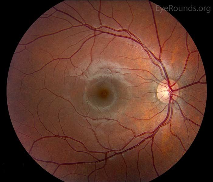 Atlas Entry - Normal fundus - adult Atlas Entry - Normal fundus - adult