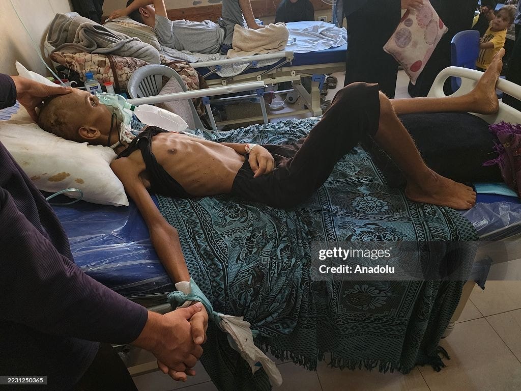 Child wounded in Gaza struggles with severe malnutrition