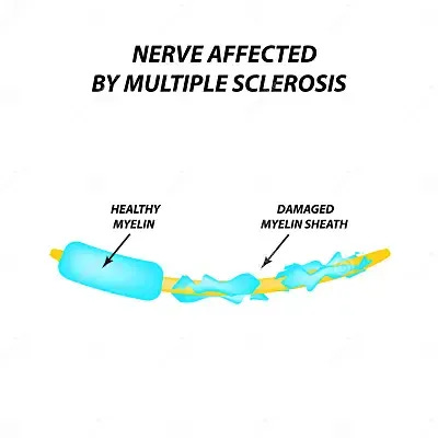How MS affects myelin sheath