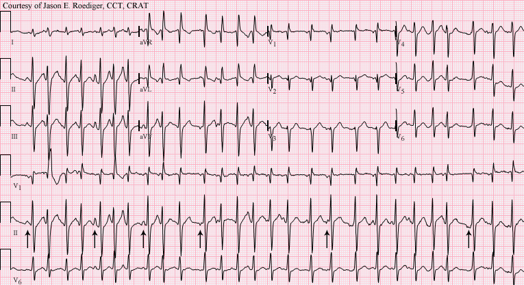 Multifocal Atrial Tachycardia Multifocal Atrial Tachycardia