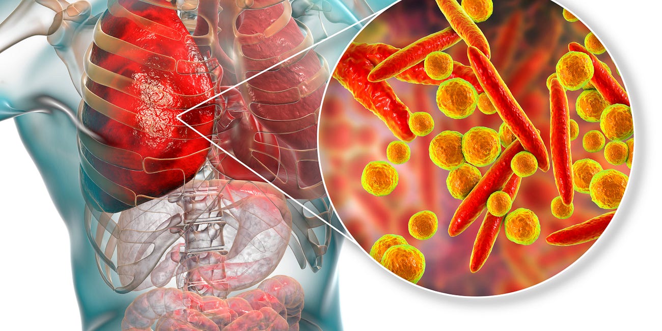 Missed Bacterial Pneumonia Cases Left Untreated Were the Majority of COVID-19 Hospital Deaths. In April 2020, I Warned About that the False Positive-Prone Non-Quantitative RT-PCR Was Deadly