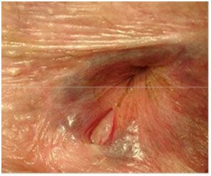 Anal Fissure | Colonoscopy Sunnybank | Sigmoidoscopy Browns Plains