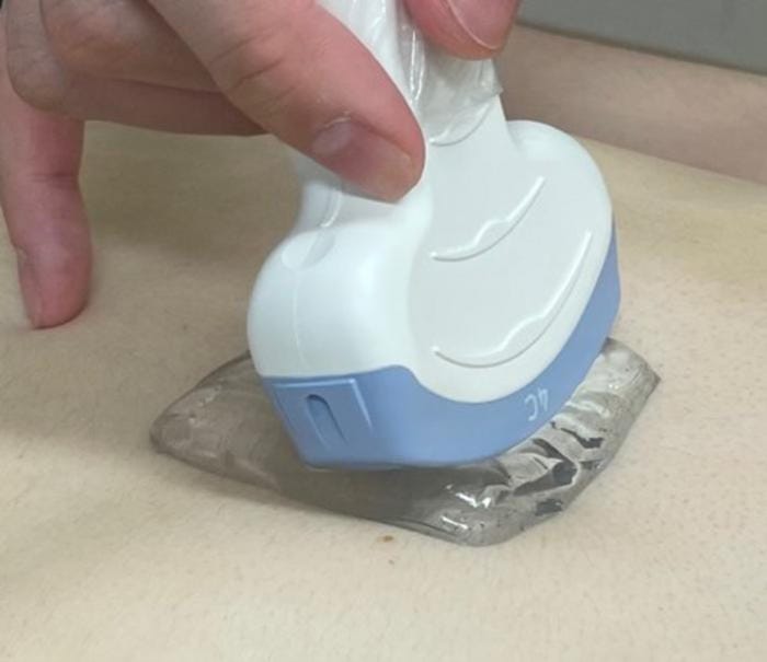 Photo of the gel being applied.