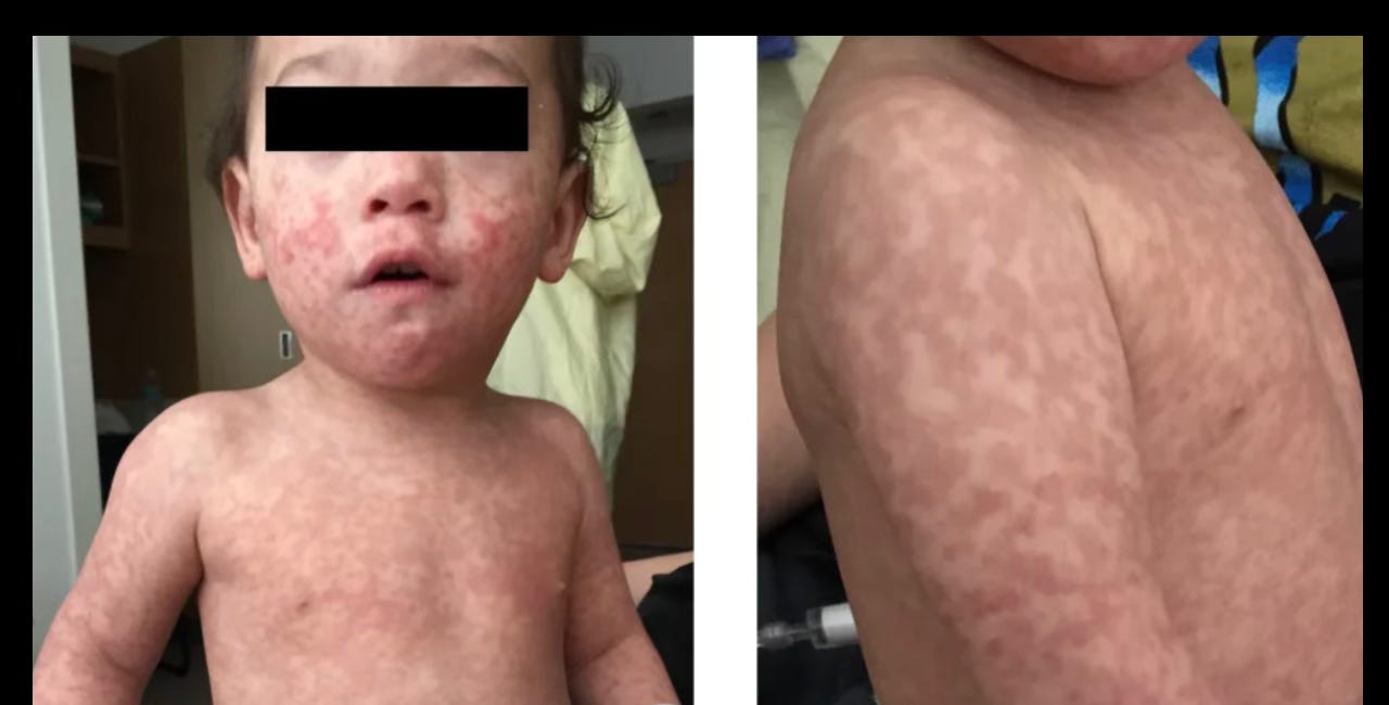 Vaccine-Associated Measles: The Overlooked Variable in Outbreak Statistics