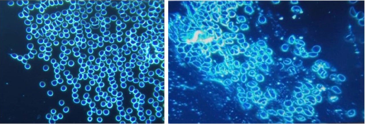 Componentes tóxicos inusuales y otros componentes extraños encontrados en viales de inyecciones experimentales de terapia génica y en la sangre de personas "vacunadas"