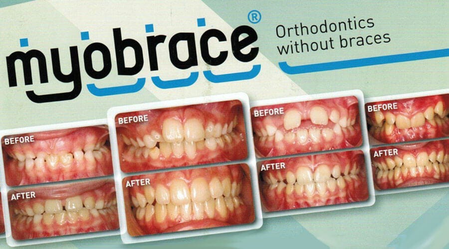 Myobrace | Yarmosky Pediatric Dentistry