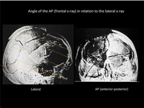Assassination of JFK - A Review of the JFK Cranial x-Rays and ...