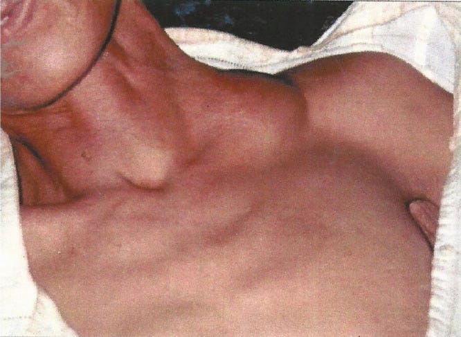 Close up of a patient's neck with their head tilted to the right and a large swollen mass under the skin on the left side, near the shoulder