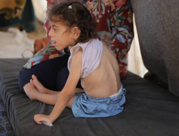 Year-old Zaater, who is half paralyzed, struggle to survive in a tent with her family due to malnutrition and lack of medicine in Deir al-Balah, Gaza...