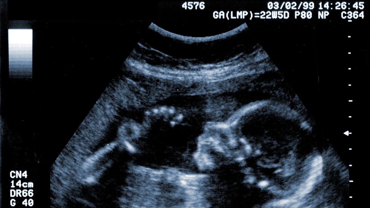 20-week scan in pregnancy | Raising Children Network