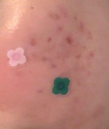 Close-up of pink and green daisy-shaped Rhode Spotwear hydrocolloid patches applied to a facial breakout for overnight treatment.