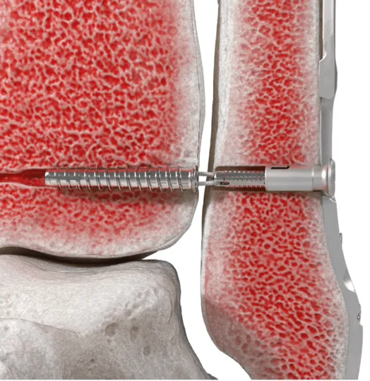 FIBULINK – for Syndesmotic Injuries