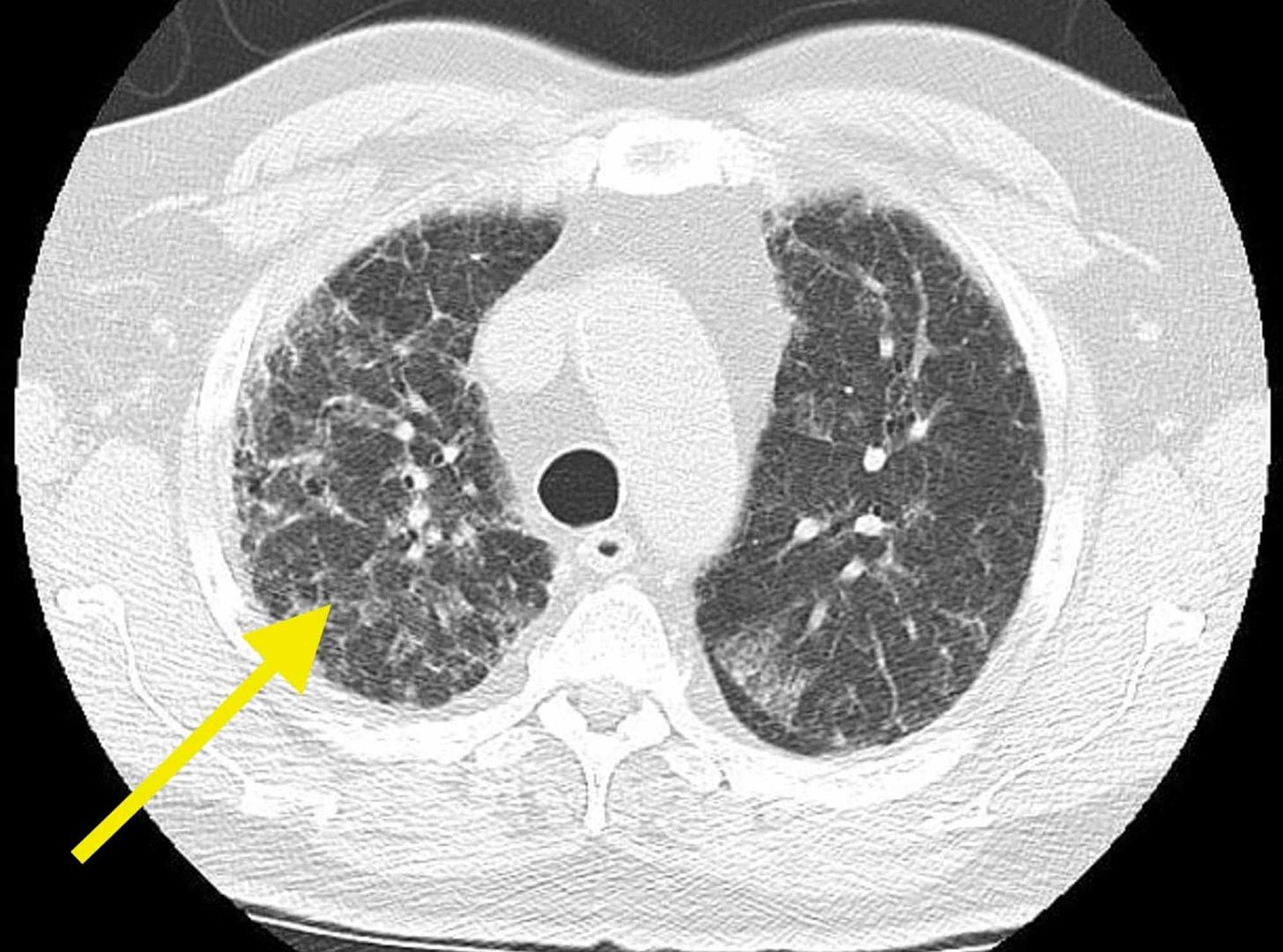 Cureus | Idiopathic Pulmonary Fibrosis: A Case of Mistaken Identity