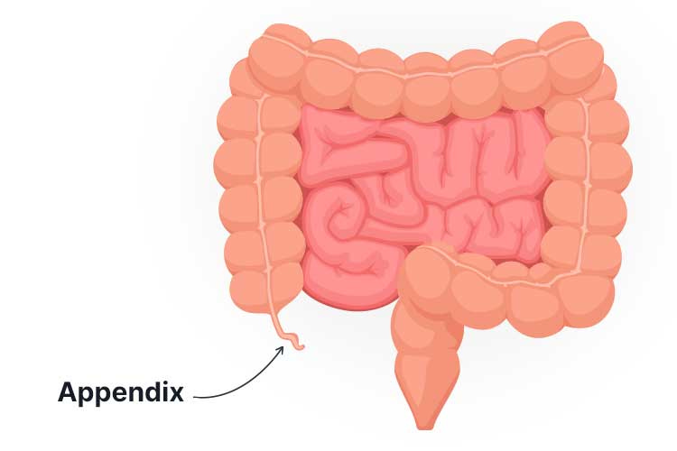 Appendicitis: Recognising the Signs | Ausmed