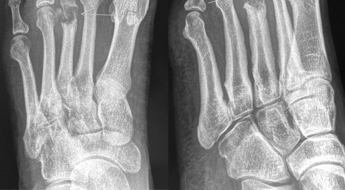 Case 22: A Swollen Forefoot
