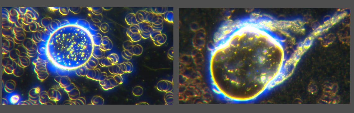 Video Of C19 Pfizer Bioweapon Shows Same Spheres And Quantum Dots We See In Live Blood. What Happens To Unvaccinated Blood When Mixed With The C19 Bioweapon? It Clots Immediately