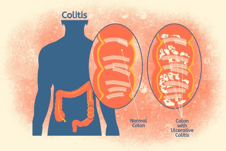 Colitis