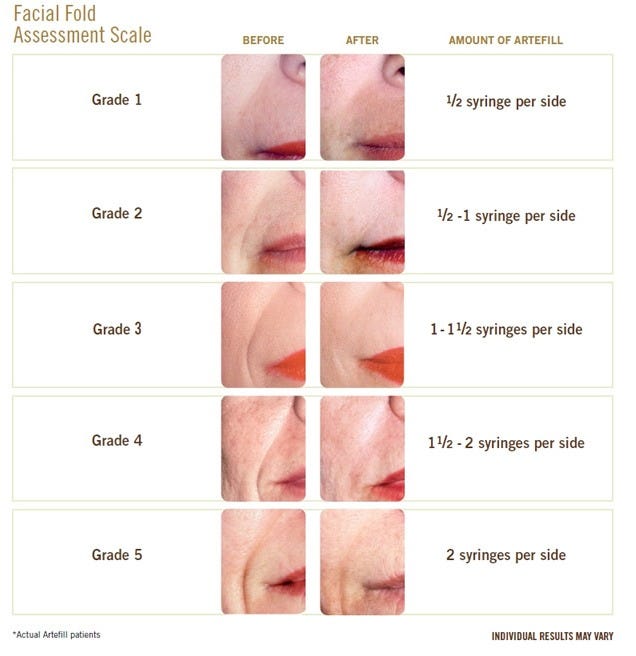 Belafill (formerly Artefill) Wrinkle Treatment - Reduce Wrinkles and Aging  - Los Angeles California Medical Spa