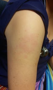 vaccine side effect redness