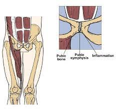 Groin Pain During Sport - What is going on? - Flexed