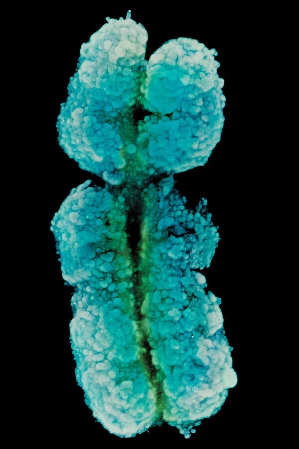 Why Do Women Have More Autoimmune Diseases? Study Points to X Chromosome -  The New York Times
