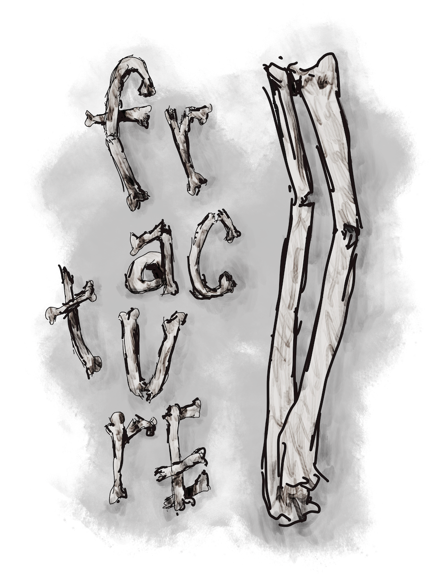 Broken bones spell out the word ‘fracture’. Sketch art by Don Rice. Broken bones spell out the word ‘fracture’. Sketch art by Don Rice.