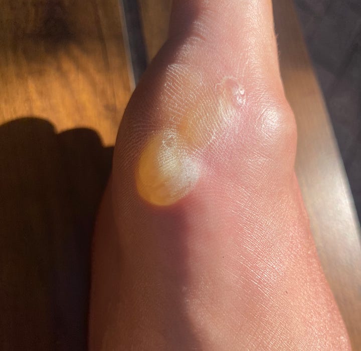 blisters forming on the side of the foot